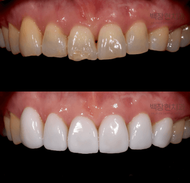 Veneer treatment planning example