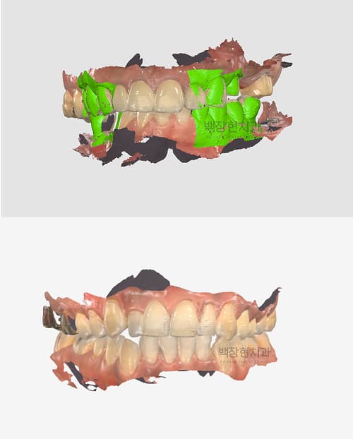 Digital scan used for clear aligner planning
