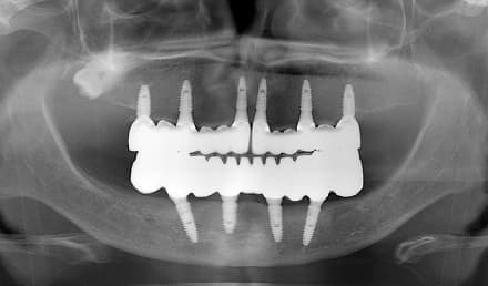 Clinical full-arch implant treatment image