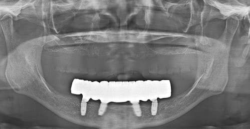 Full-arch implant radiograph